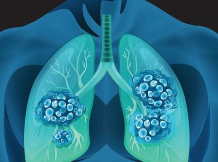 Hutchmed reports phase 3 SANOVO data for first‑line lung cancer